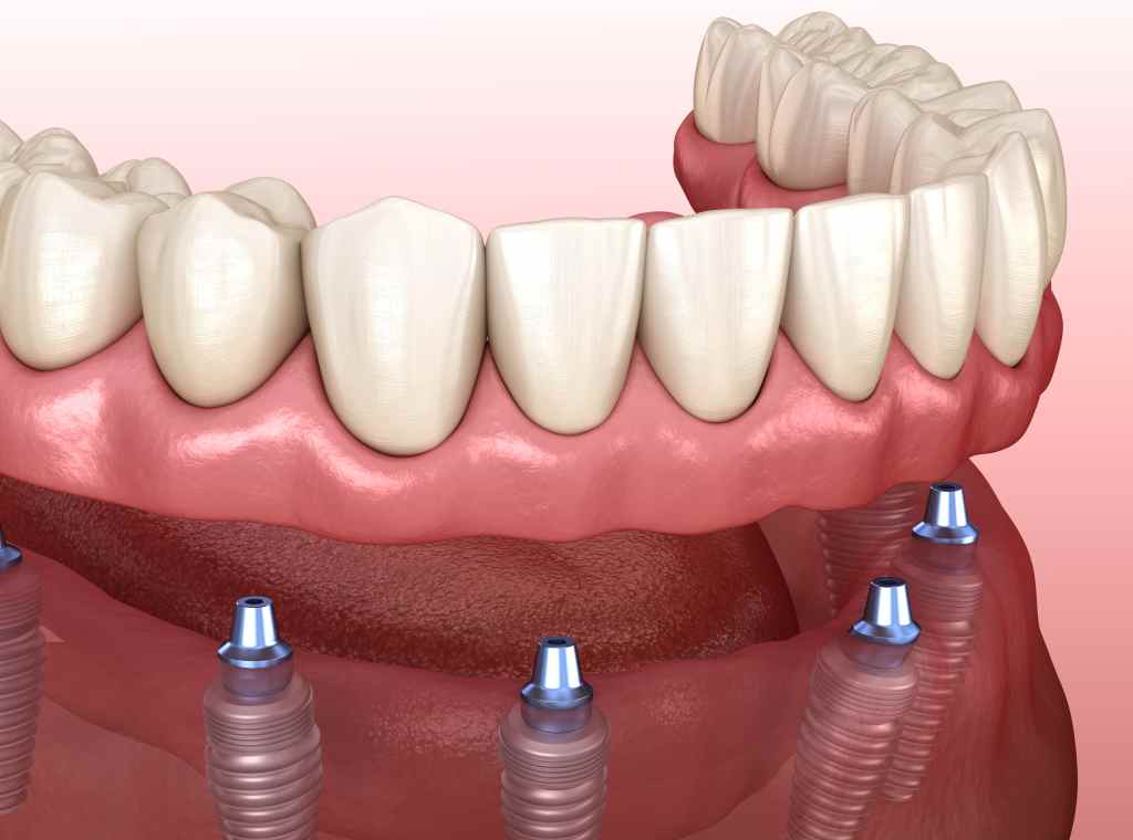a full arch of teeth with implants for placement underneath it