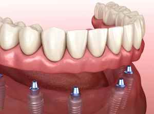 a full arch of teeth with implants for placement underneath it