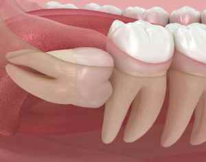 a wisdom tooth that is impacted onto the molar infront of it